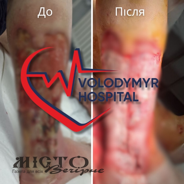 У Володимирському ТМО проводять пересадку шкіри із застосуванням аутодермопластики 